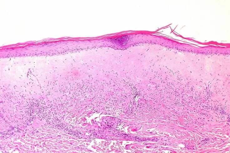 Крауроз 1 стадия фото Pin on Forensic pathology - microscopy