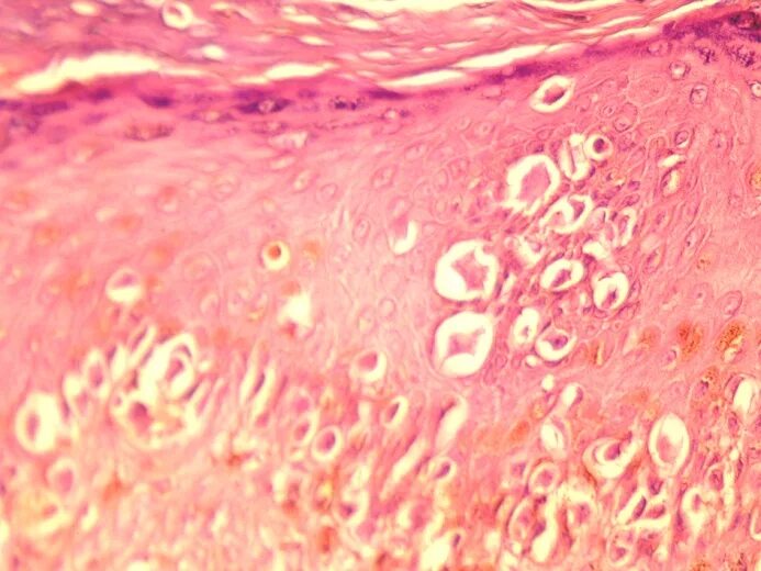 Крауроз у женщин фото симптомы лечение File:Superficially spreading melanoma.jpg - Wikimedia Commons