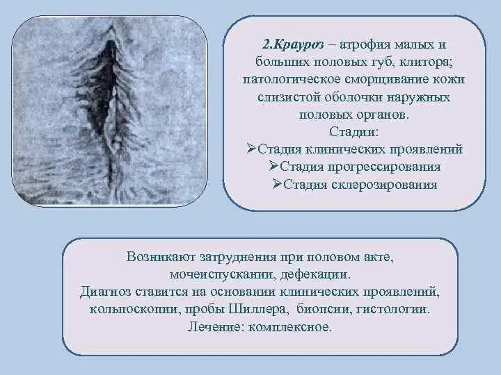 Крауроз у женщин фото симптомы лечение Заболевание вульвы и половых губ