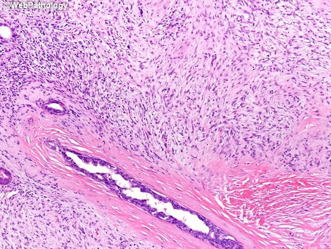 Крауроз у женщин фото симптомы лечение Webpathology.com: A Collection of Surgical Pathology Images