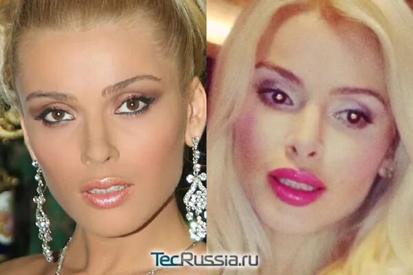 Кравец до пластики фото Алена Кравец до и после пластики - фото и результаты операций
