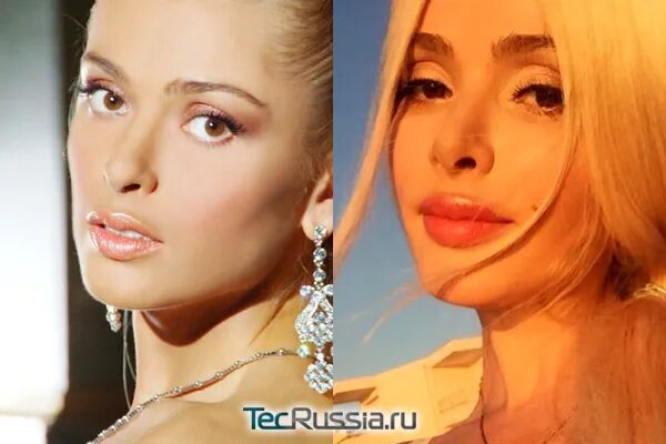 Кравец до пластики фото Алена Кравец до и после пластики - фото и результаты операций