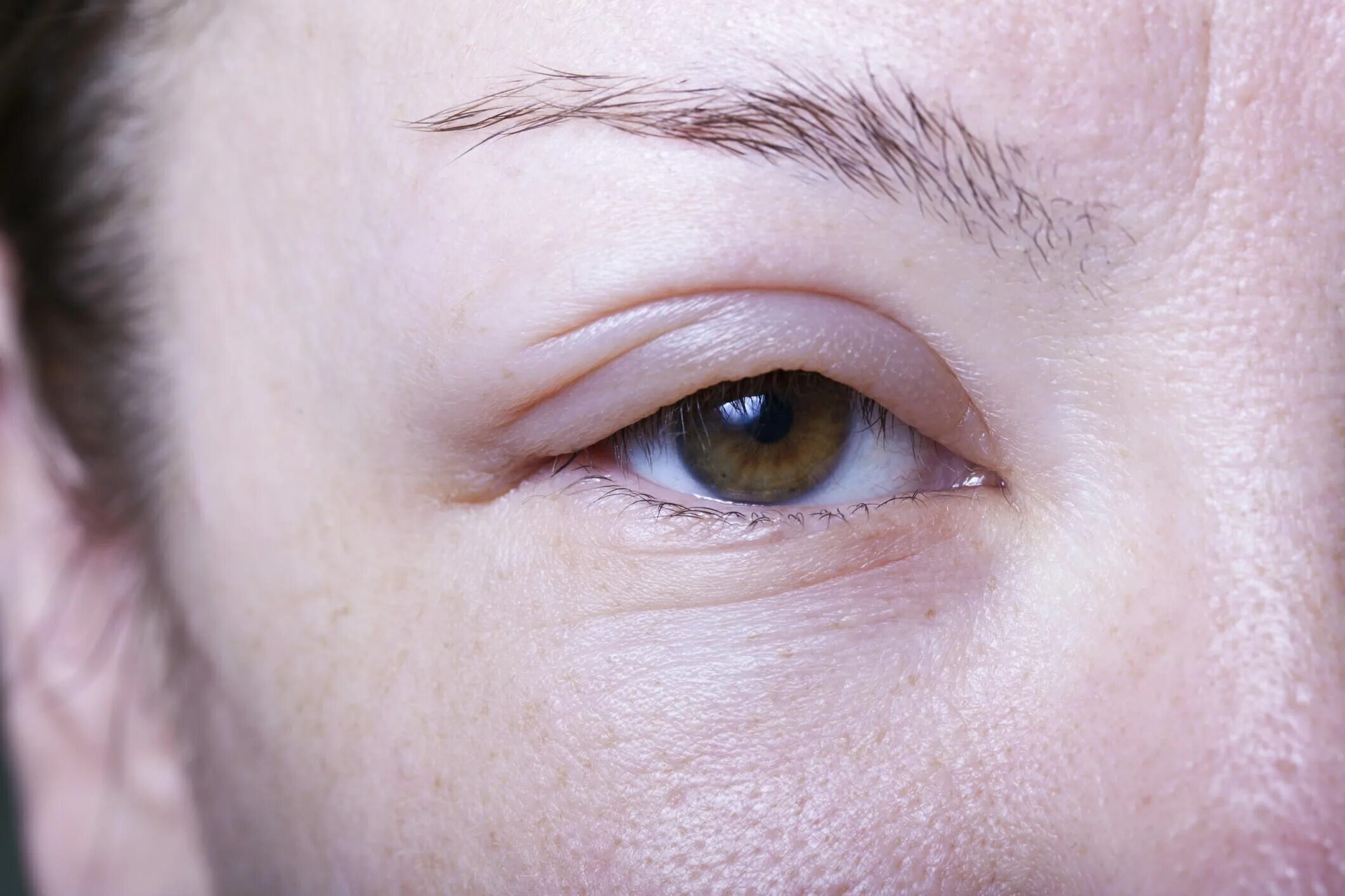 Края века фото Hereditary Angioedema Symptoms and Signs - Rare Disease Advisor