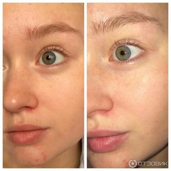 Крем до и после фото Отзыв о Крем для лица Librederm увлажняющий с гиалуроновой кислотой Достойный кр
