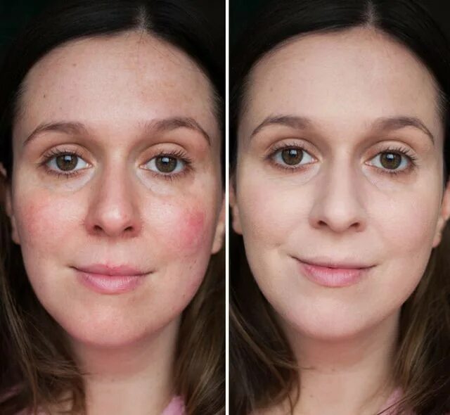 Крем до и после фото применения Купить Nano Perfect Face - маска для лица - цена: 0 смн. в аптеке Аптека Нова