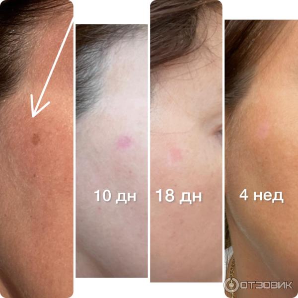 Крем экспигмент фото до и после Отзыв о Крем отбеливающий EXPIGMENT Отличный результат!