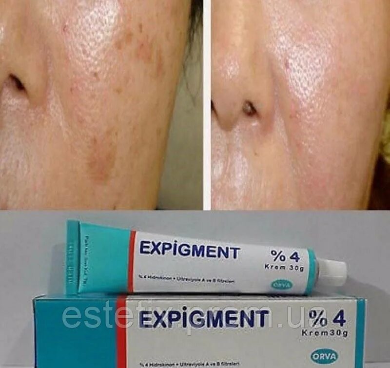 Крем экспигмент фото до и после Экспигмент Expigment отбеливающий крем от пигментных пятен 4%, цена 250 грн в Ха