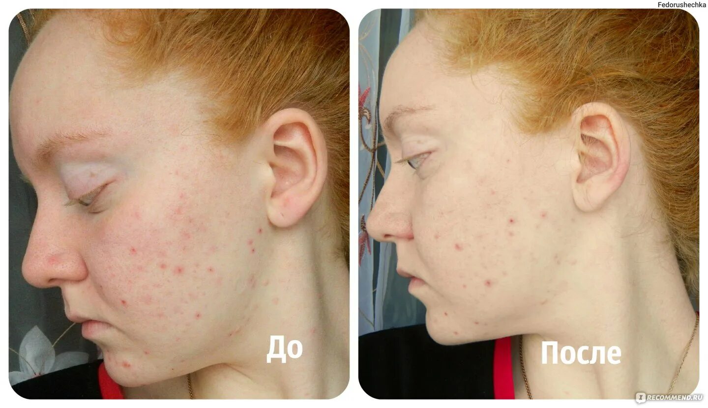 Крем экспигмент фото до и после Лосьон-эксперт для лица V.i.Cosmetics для проблемной кожи "Beauty effect" - "Пре