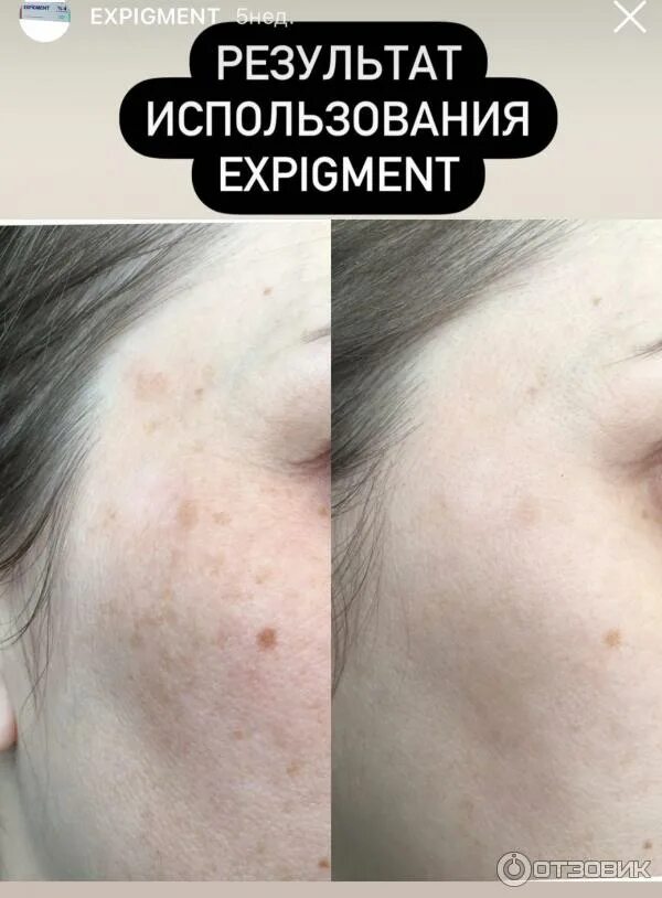 Крем экспигмент фото до и после Отзыв о Крем отбеливающий EXPIGMENT Эффективное средство от пигментации