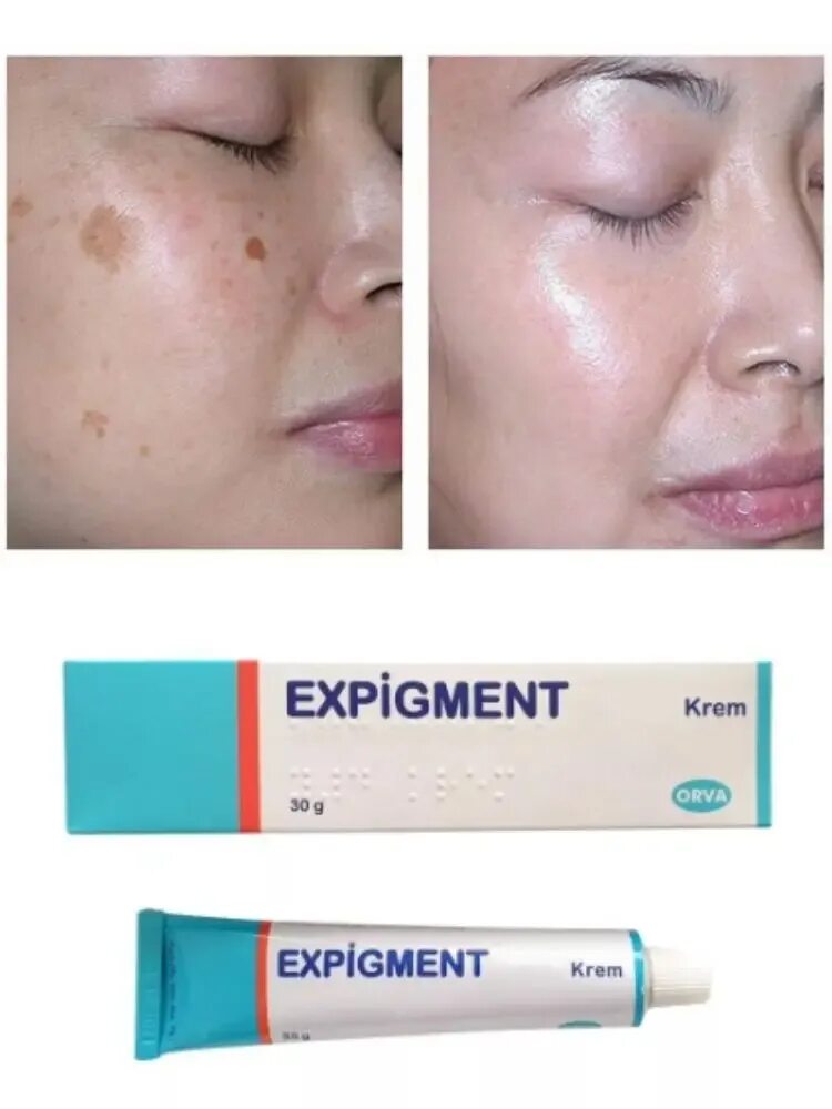 Крем экспигмент фото до и после Expigment Hydroquinone Face and Skin Acne Treatment Fine Wrinkles Skin Bleaching