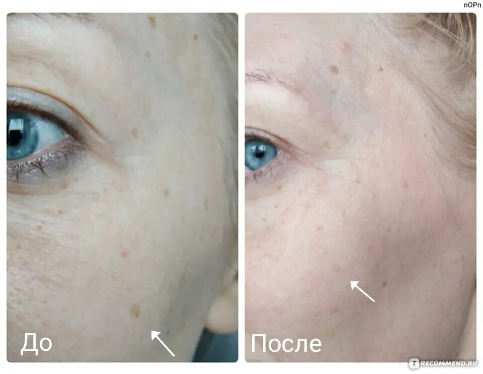 Крем экспигмент фото до и после Крем отбеливающий Expigment с содержанием гидрохинона 4% - "У меня пигментные пя
