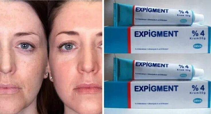 Крем экспигмент фото до и после Expigment Krem ile Cilt Lekelerine Son Expigment krem; Yüzünüzde yada cildinizin