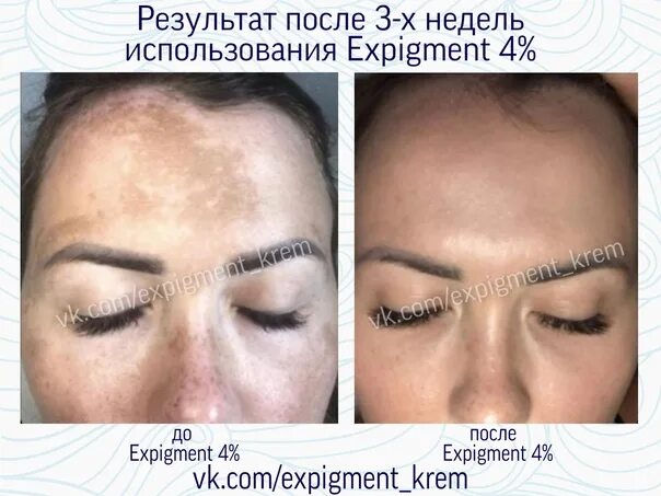 Крем экспигмент фото до и после ❗ Result for three weeks of using Expigment 4% The most valuable thing for us is