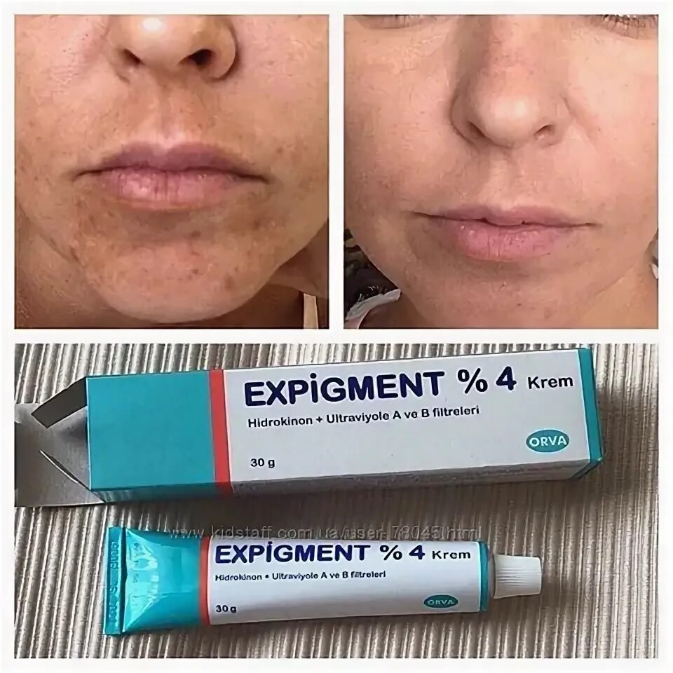 Крем экспигмент фото до и после Красота и здоровье: Expigment 2 - купить по выгодной цене в интернет-магазине Al