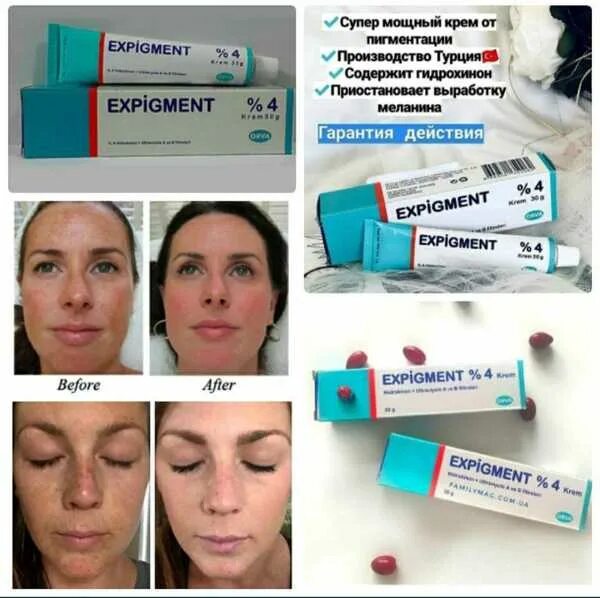 Крем экспигмент фото до и после крем expigment - Moda va stil - OLX.uz