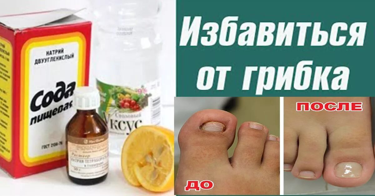 Крем от грибка ног фото Лечение грибка ногтей прополисом: как это делается?