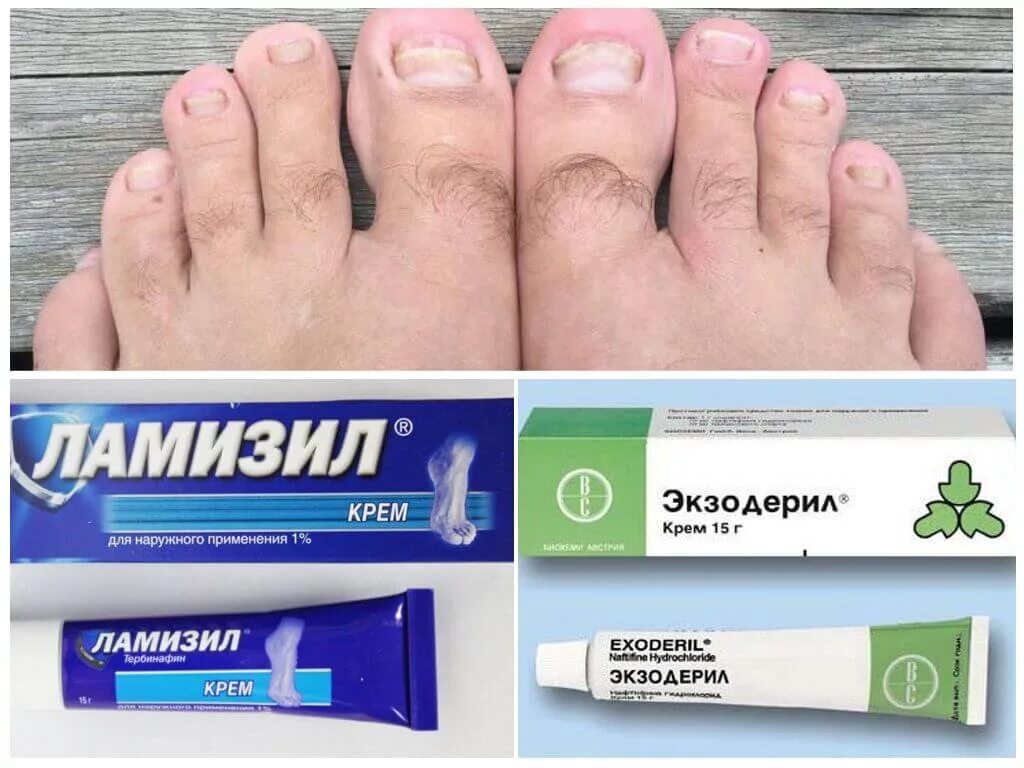 Крема от грибка фото Средство от грибка ногтей: мази, кремы, советы