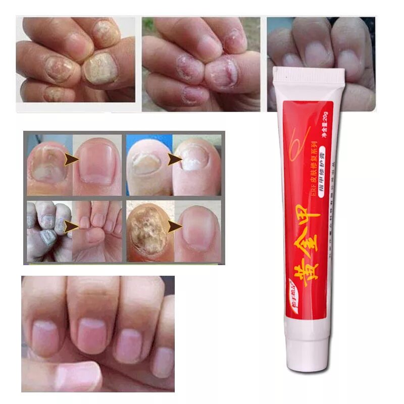 Крема от грибка фото Nail Fungus Treatment / Onychomycosis Paronychia / Anti Fungal Nail Infection Go