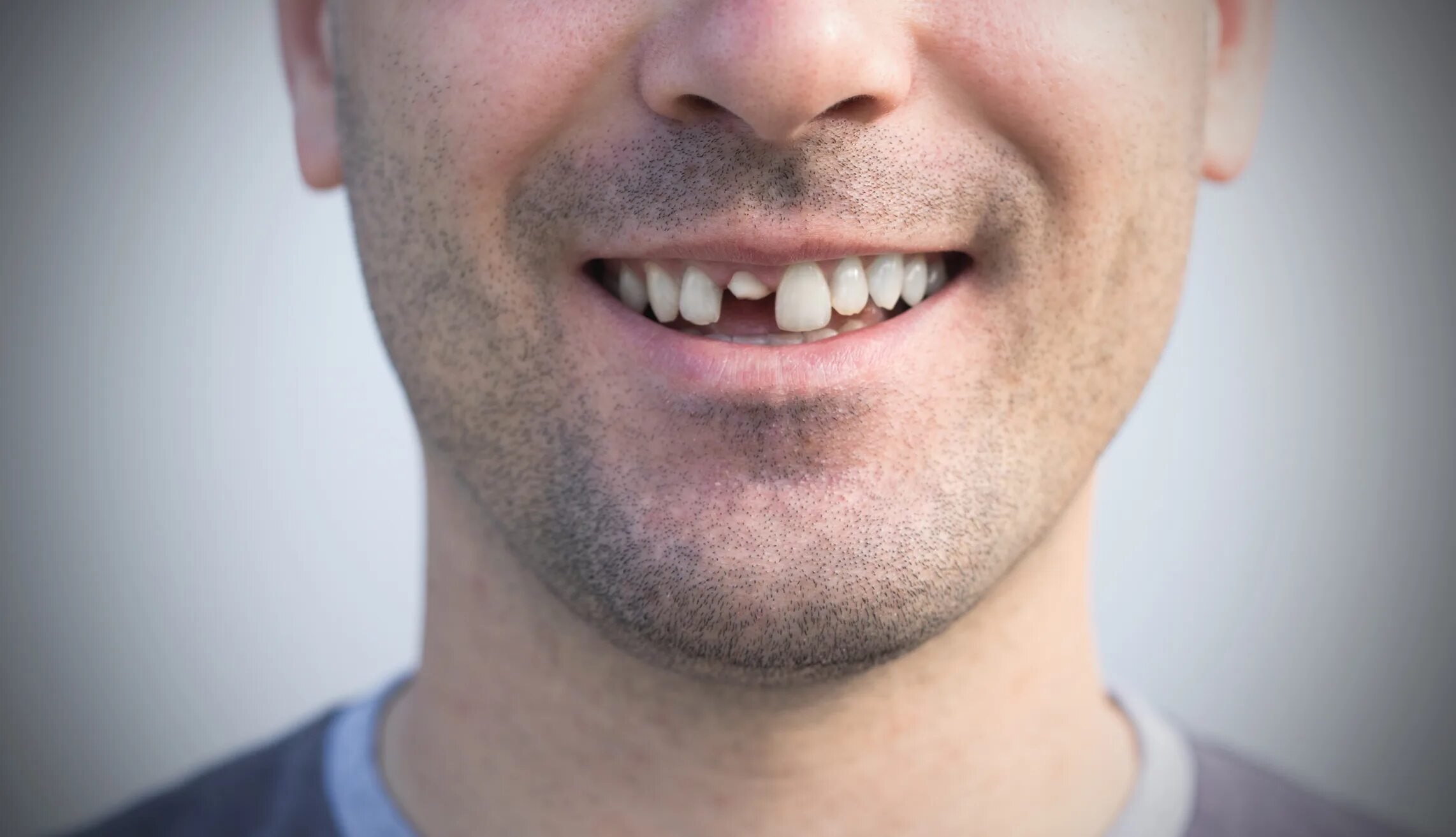 Крупные зубы фото Man’s broken tooth leads to open-heart surgery, 7-month ordeal after docs though