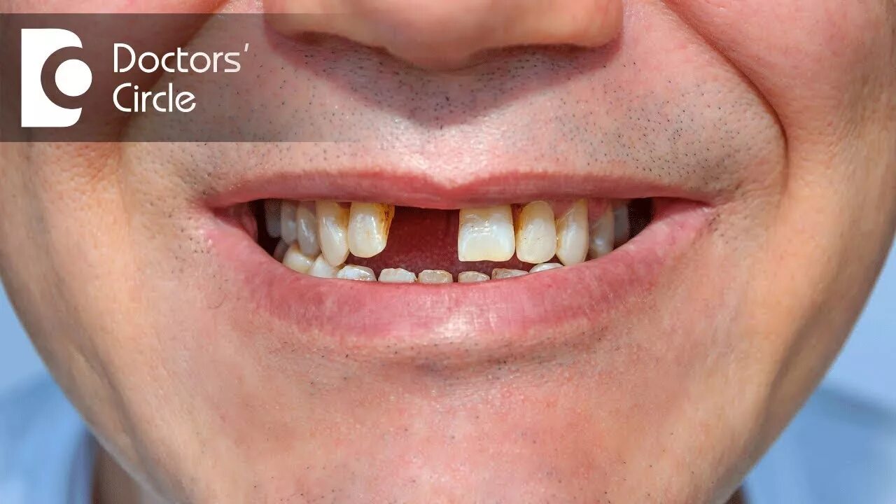 Крупные зубы фото Is a Dental Bridge removable? - Dr. Mohammed Fayaz Pasha - YouTube