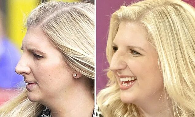 Крупный нос прическа для женщины Rebecca Adlington reported to have had cosmetic surgery on her nose