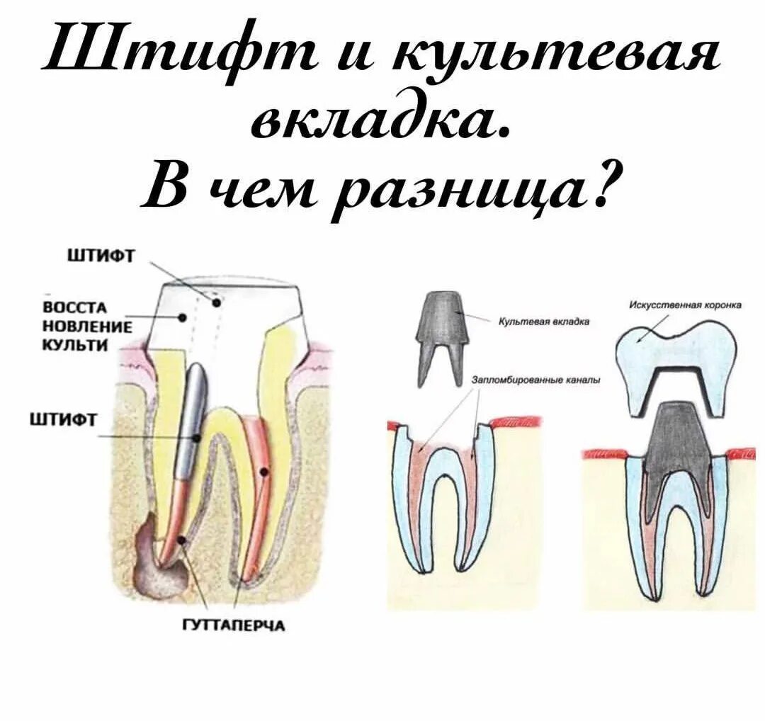 Культевая вкладка зуба фото Сегодня немного обратимся к работе ортопедов и поговорим о штифте и культевой вк
