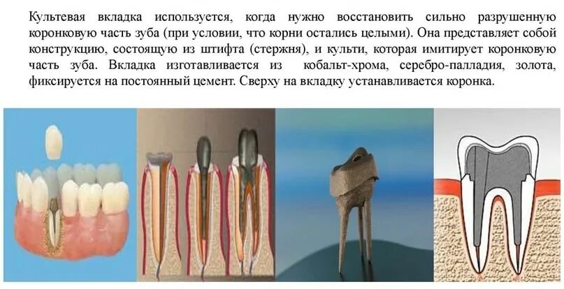 Культевая вкладка зуба фото Стоматолог-ортопед (Протезист) - Центр Семейной Медицины в г. Пушкин