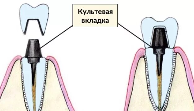 Культевая вкладка зуба фото Сколько стоит восстановление зуба под коронку? Культевая вкладка. Пломба со штиф