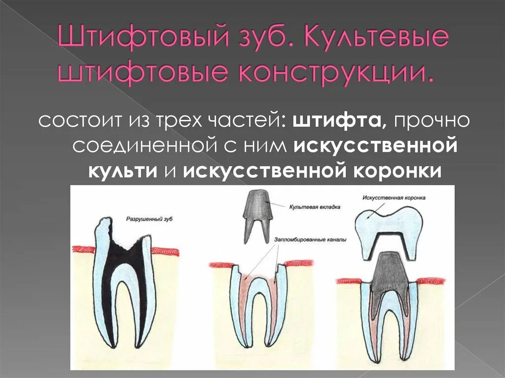 Культевая вкладка зуба фото Архивы Штифты - Стоматология