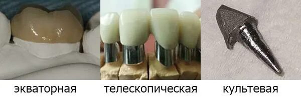 Культя зуба под коронку как выглядит Культевые штифты