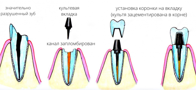 Культя зуба под коронку как выглядит Культевая штифтовая цельнолитая вкладка под коронку: изготовление, установка на 