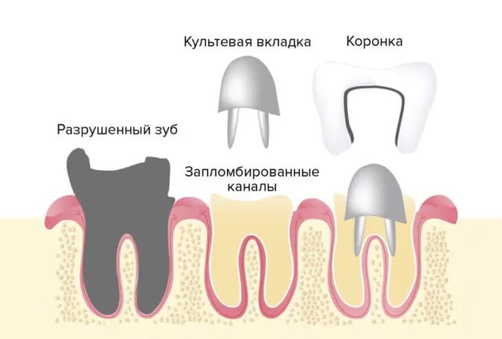 Культя зуба под коронку как выглядит Культевая вкладка литая со штифтом лабораторным методом