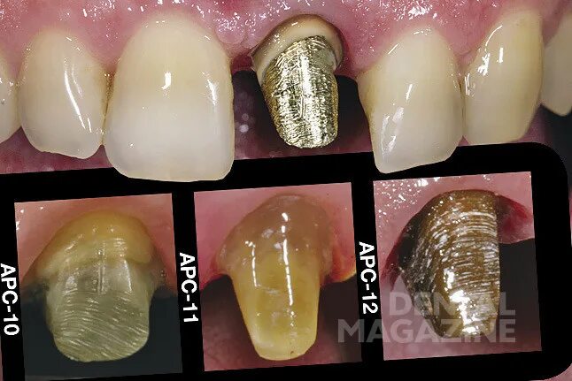 Культя зуба под коронку как выглядит Попасть в цвет? Нет проблем! - DENTALMAGAZINE.RU