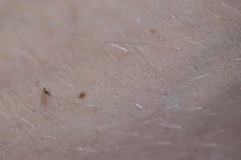 Лосиные вши укусы на человеке фото Incident, událost Vyhovět Škarpa tea tree oil na vši kukuřice Třetí faktor