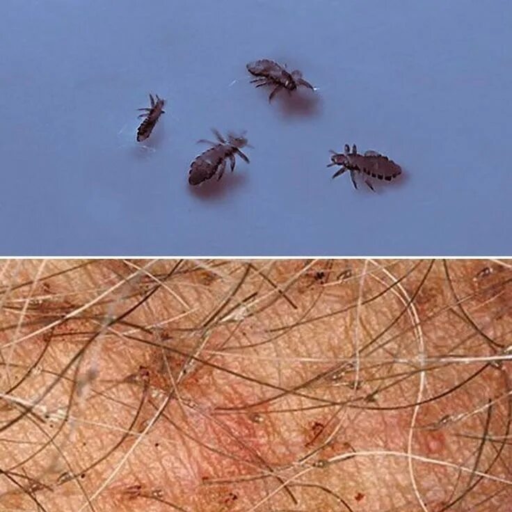 Лосиные вши укусы на человеке фото Pin på piqures d insectes