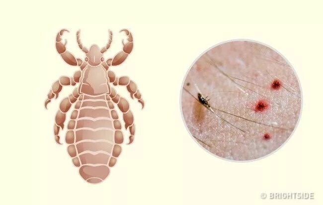 Лосиные вши укусы на человеке фото 10 Bug Bites Anyone Should Be Able to Identify Bug bites, Insect bites, Bugs