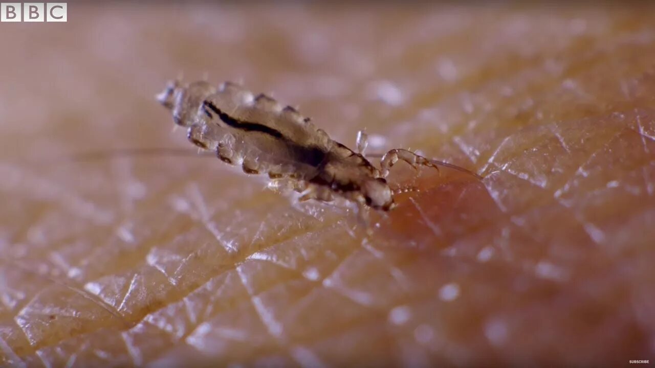 Лосиные вши укусы на человеке фото Presenter Gives Himself Head Lice On Purpose! Earth Lab - YouTube