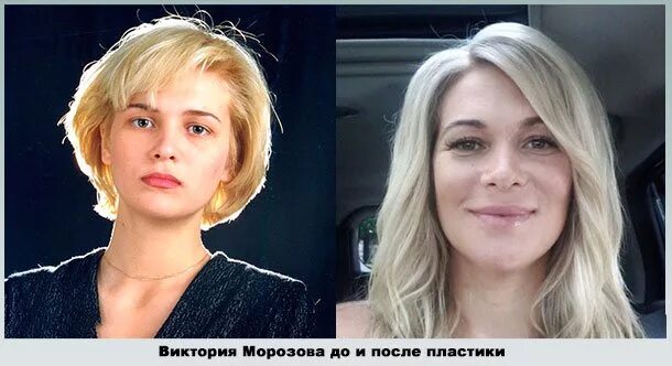 Макарская до и после пластики фото Виктория морозова в мюзикле метро - Фото