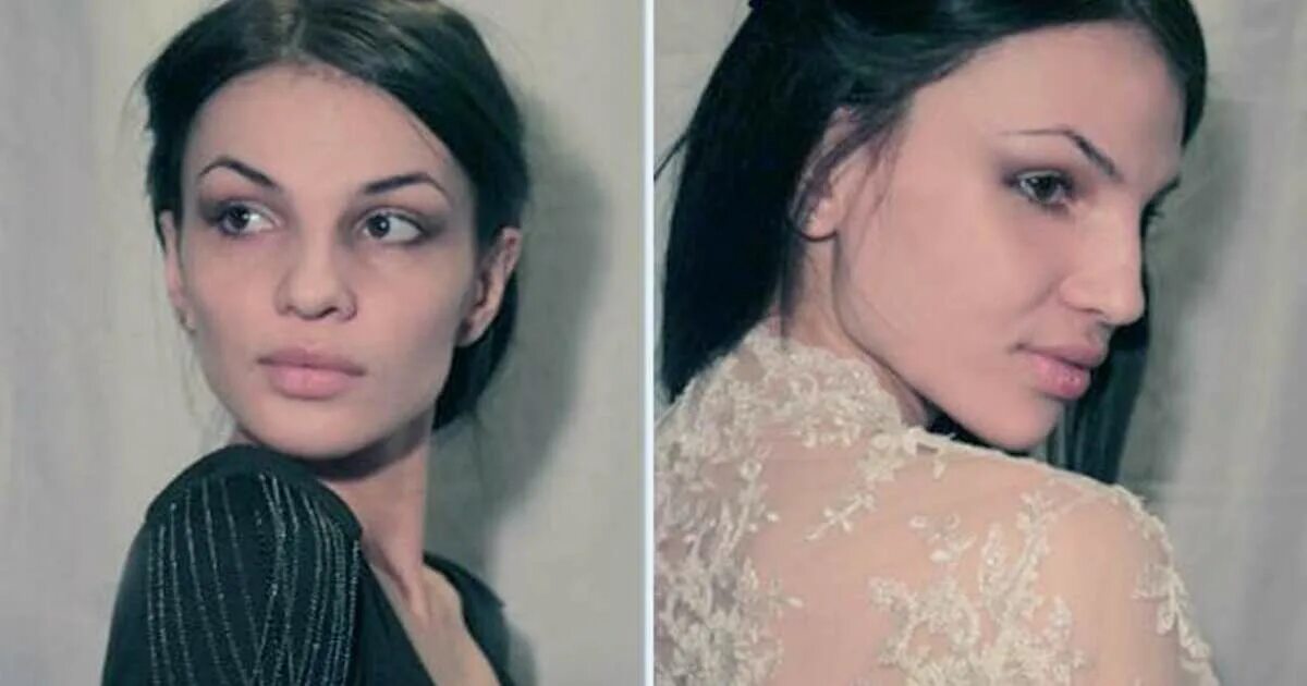 Марина зуева фото до и после пластики Фото жертвы пластической хирургии, умершей после операции на лице - 26.04.2018 -