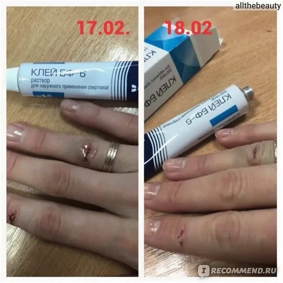 Медицинский клей фото Медицинский клей ВербаФарм БФ-6 - "Отличное средство для заживления ран. Помогло