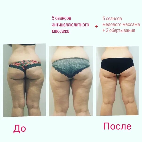 Медовый массаж до и после фото Дорогие девушки, ищу моделей на антицеллюлитный.. Воронеж Ищу модель / мастера В
