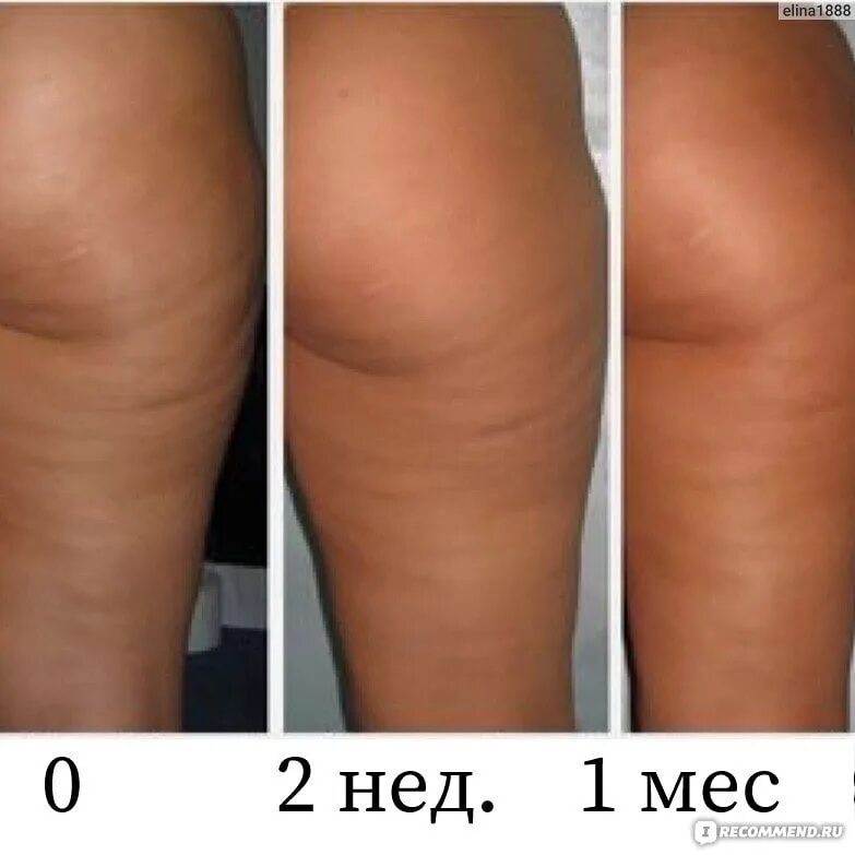 Медовый массаж отзывы до и после фото Отек после массажа - найдено 85 картинок