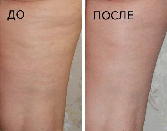 Медовый массаж отзывы до и после фото Роликовый - Масаж в Вишневе - OLX.ua