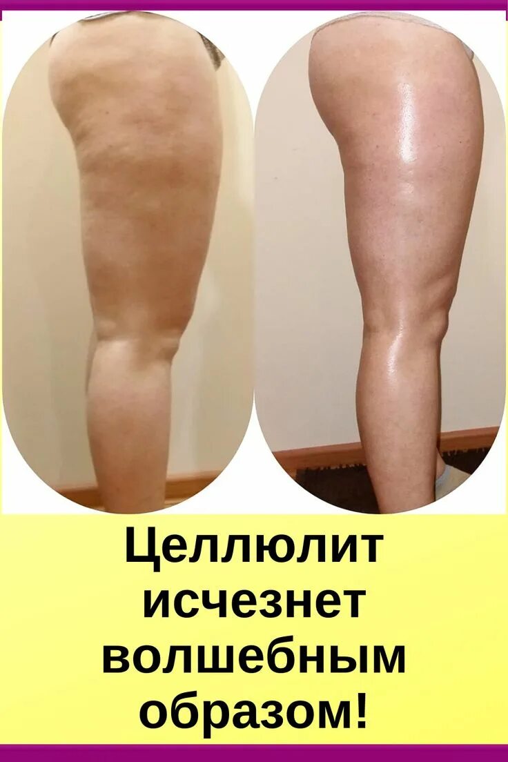Медовый массаж отзывы до и после фото Пин от пользователя Оксана Тимчишин на доске Здоро'я ніг Целлюлит, Товары для зд