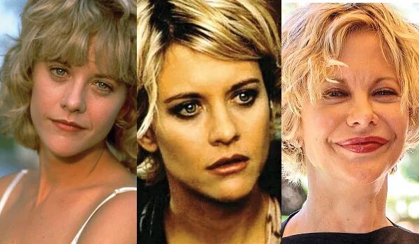 Мег райан фото до и после пластики Meg Ryan Plastic Surgery Before and After Pictures 2024