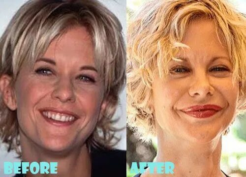 Мег райан фото до и после пластики Meg Ryan Plastic Surgery Before And After Shocking Facelift Plastic surgery, Meg