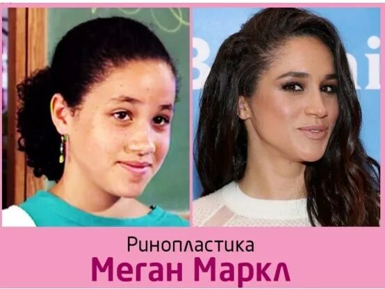Меган маркл до пластики и после фото Меган Маркл какие делала пластические операции, фото до и после пластики?