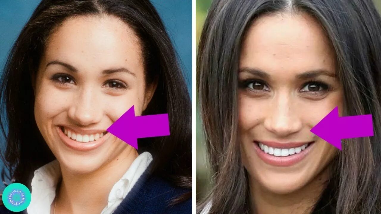 Меган маркл до пластики и после фото Meghan Markle Transformation, Weight Loss and Plastic Surgery - YouTube