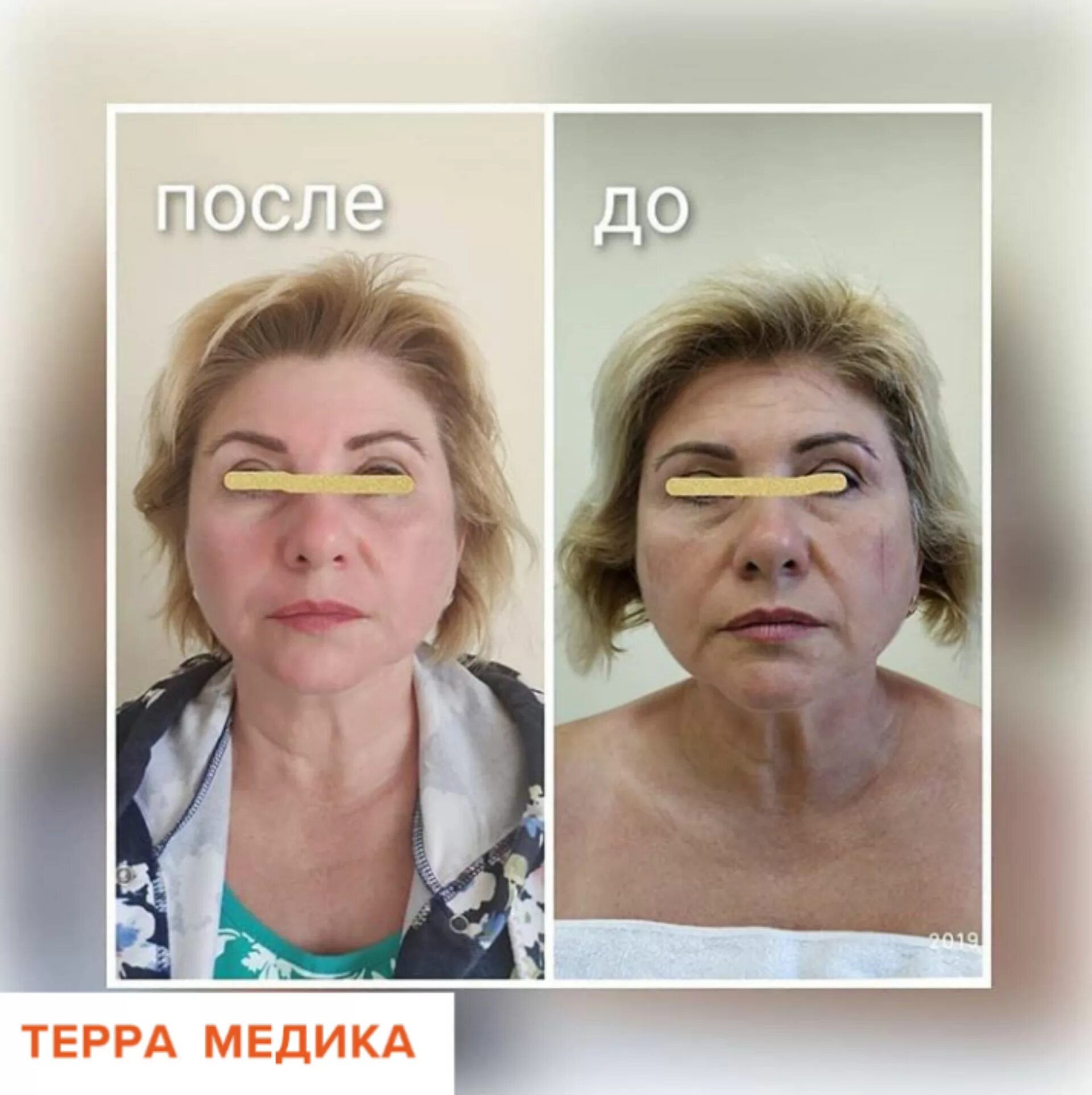 Миофасциальный массаж лица фото до и после Миофасциальный омолаживающий массаж лица - эффективная альтернатива инъекциям и 