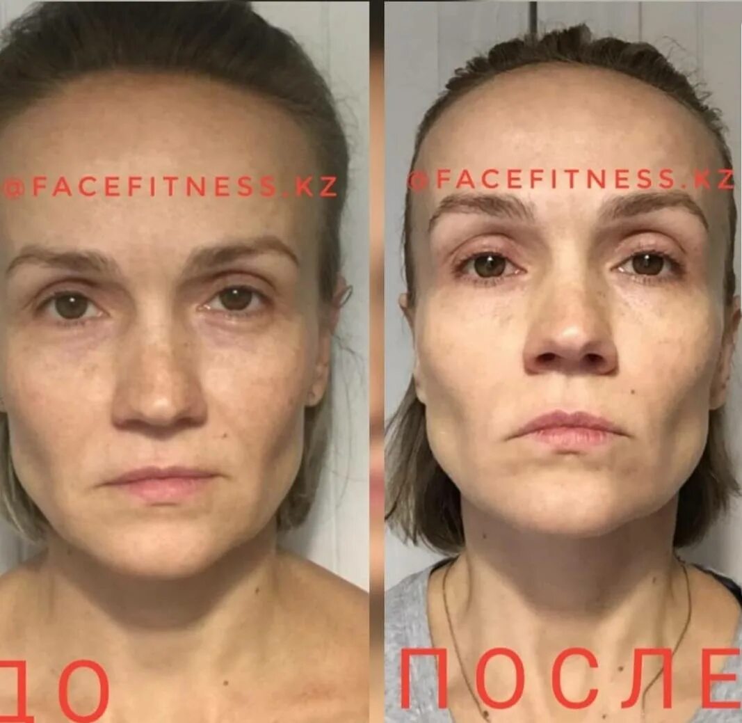 Миофасциальный массаж лица фото до и после Миофасциальный массаж лица: техника выполнения, отзывы